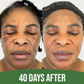 Intense Discoloration Treatment